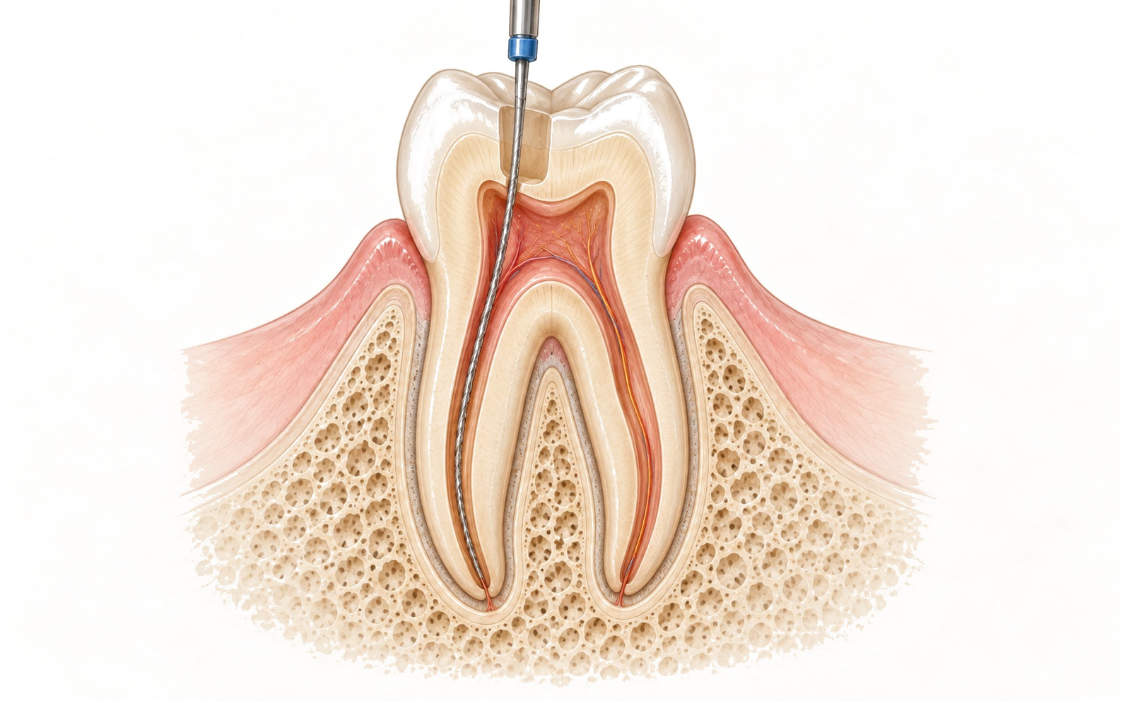 Przekrój zęba trzonowego podczas leczenia kanałowego z komorą miazgi, kanałami korzeniowymi i pilnikiem endodontycznym