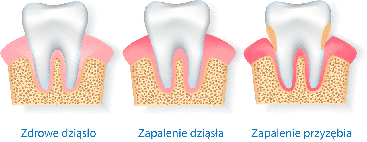 periodontologia etapy periodontologia etapy